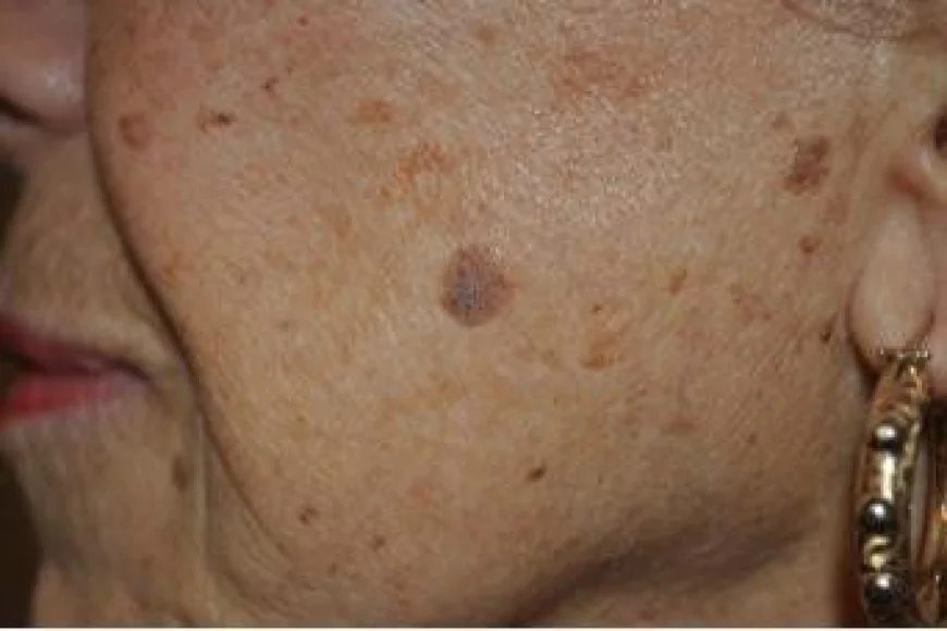 Everything You Need to Know About Seborrheic Keratosis Treatment in Dubai