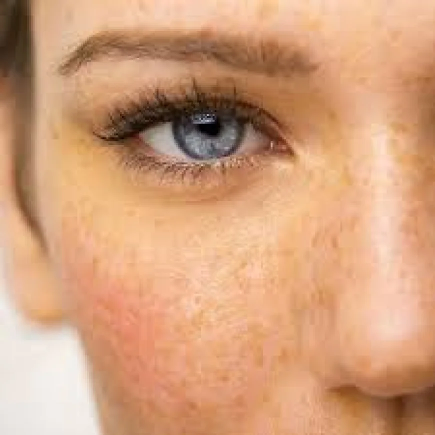 Best Benefits of Skin Pigmentation Treatment in Dubai