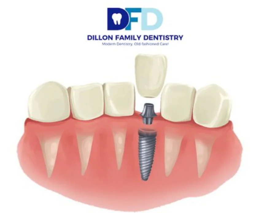 Dental Implants in Haverford, PA | Main Line Implant Care