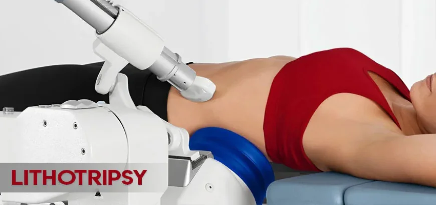 Lithotripsy Treatment: A Proven Solution for Kidney Stones