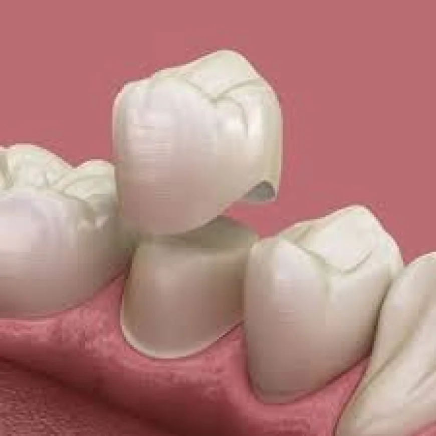 Zirconia Crowns in Dubai for a Natural-Looking Smile Transformation