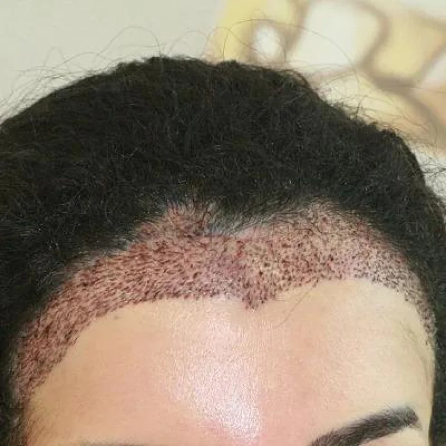 Can a Female Hair Transplant Restore a Receding Hairline?