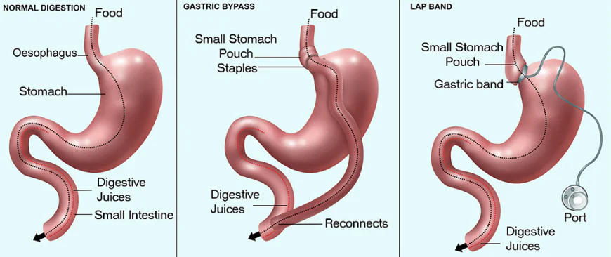 How Bariatric Surgery Helps Manage Obesity and Related Health Conditions