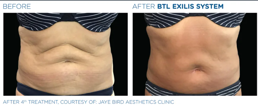 Skin Tightening Treatments for Firmer and Younger-Looking Skin