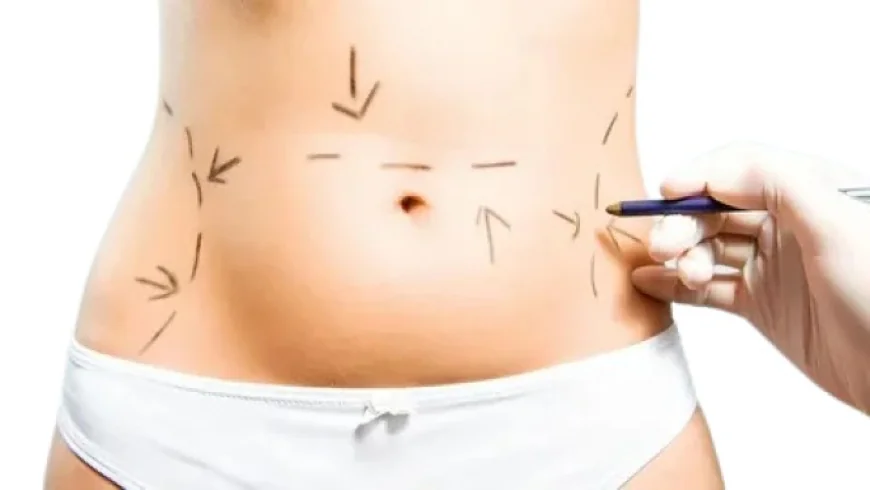 The "Shrink-Wrap" Effect: BodyTite Liposuction Riyadh Explained