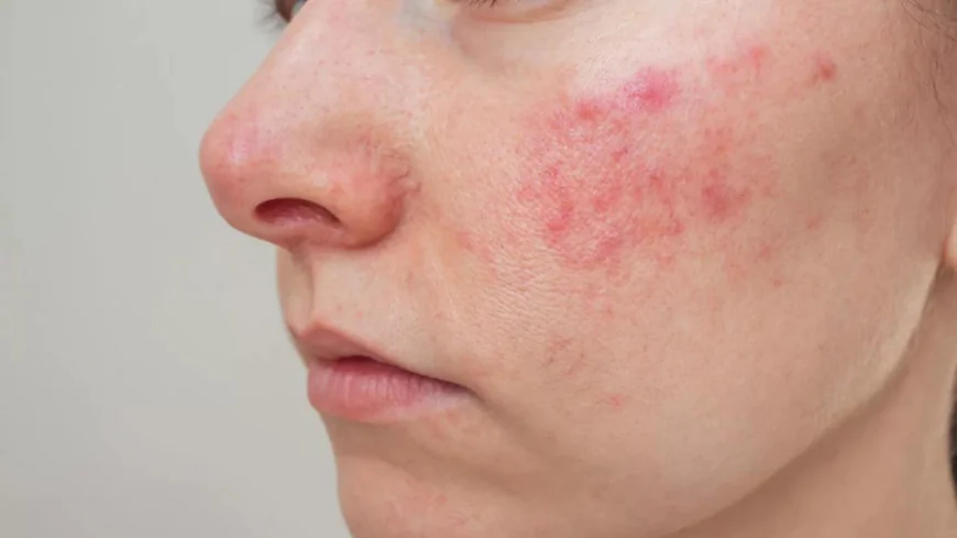 What Rosacea Treatment shows about triggers