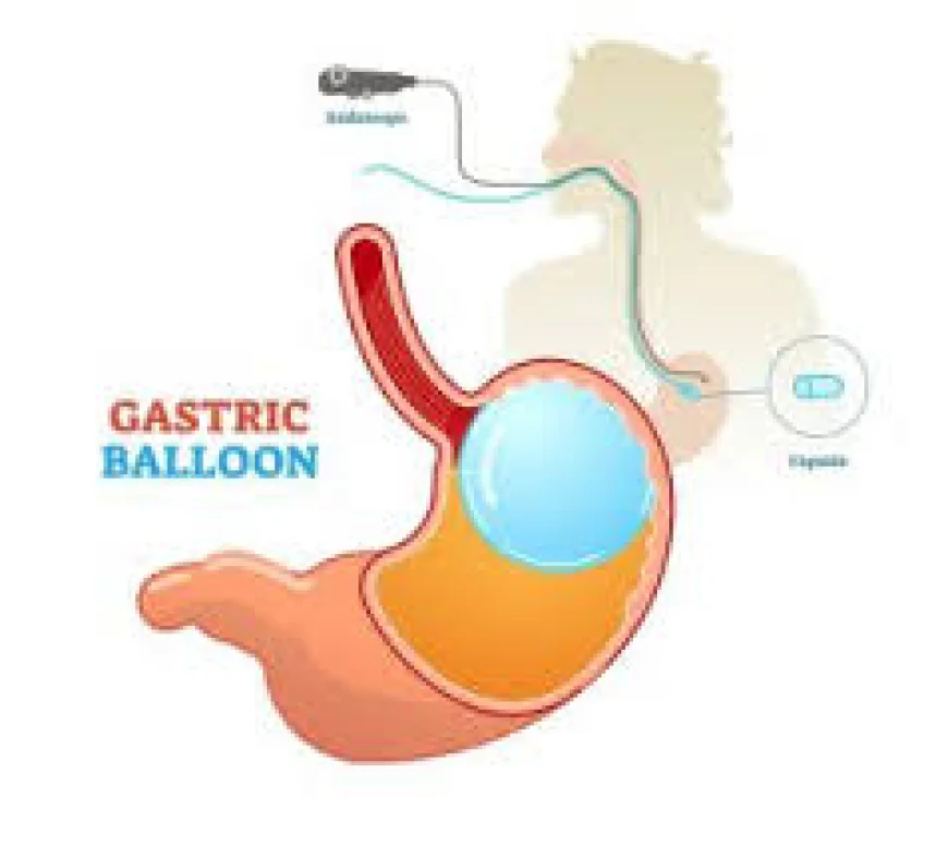 Understanding the Benefits of Gastric Balloon in Dubai for Effective Weight Loss