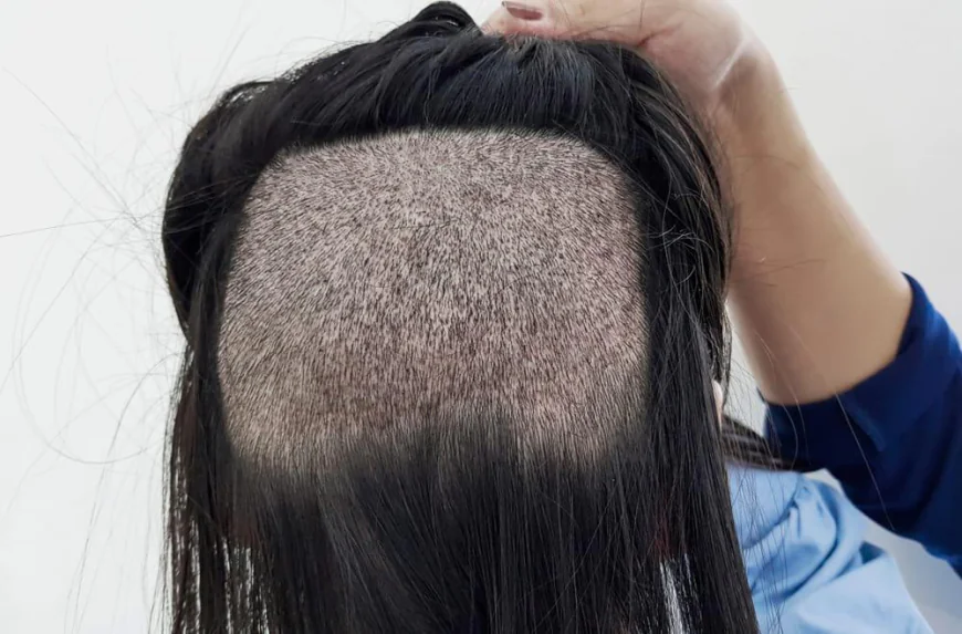 How Many Grafts Are Typically Required for FUE Hair Transplant?