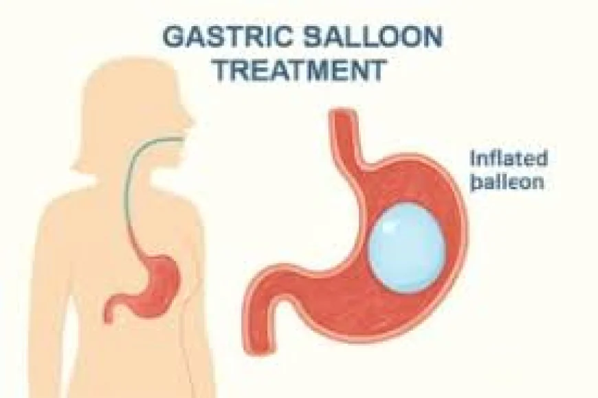MedCell Laparoscopic Balloon in Dubai: Benefits for Effective Weight Management