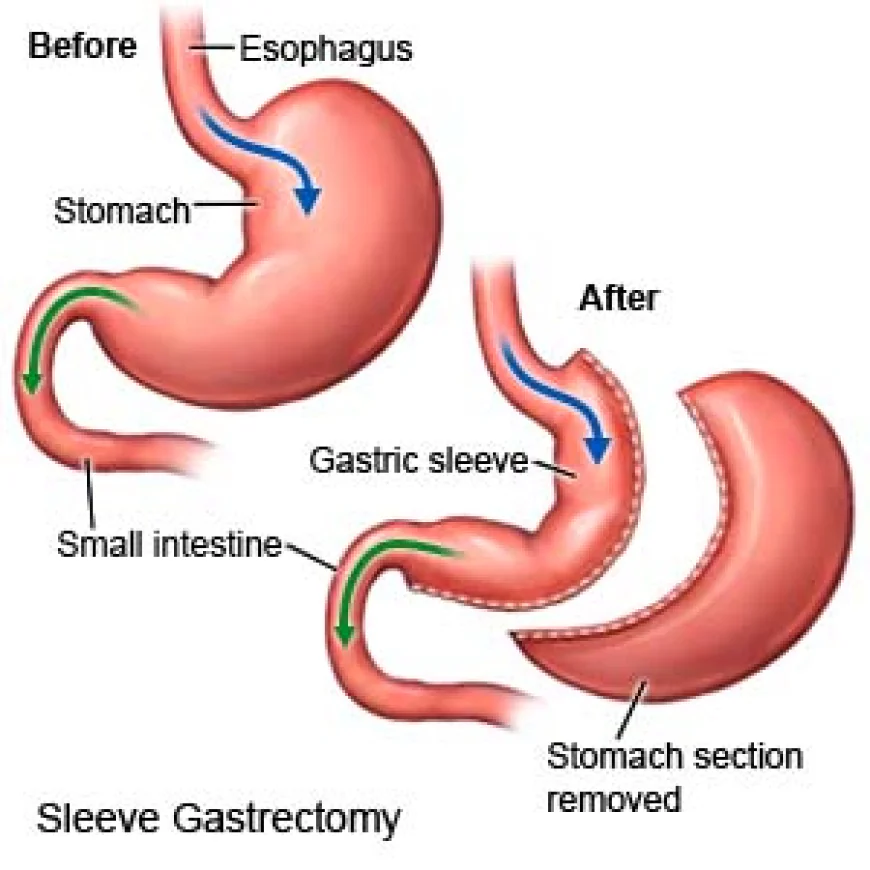 Laparoscopic Sleeve Gastrectomy in Dubai – Safe and Effective Weight Loss Solution