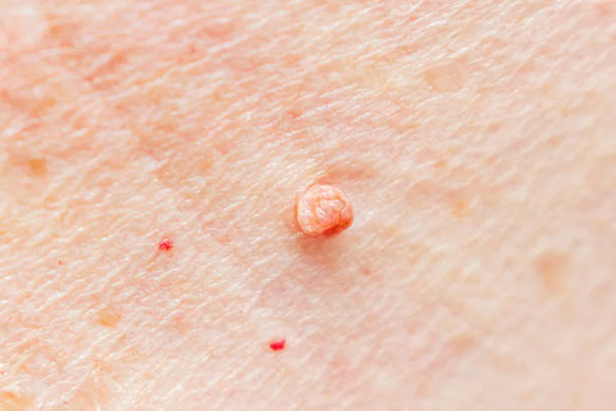 Can Skin Tag Removal Improve Skin Appearance Fast