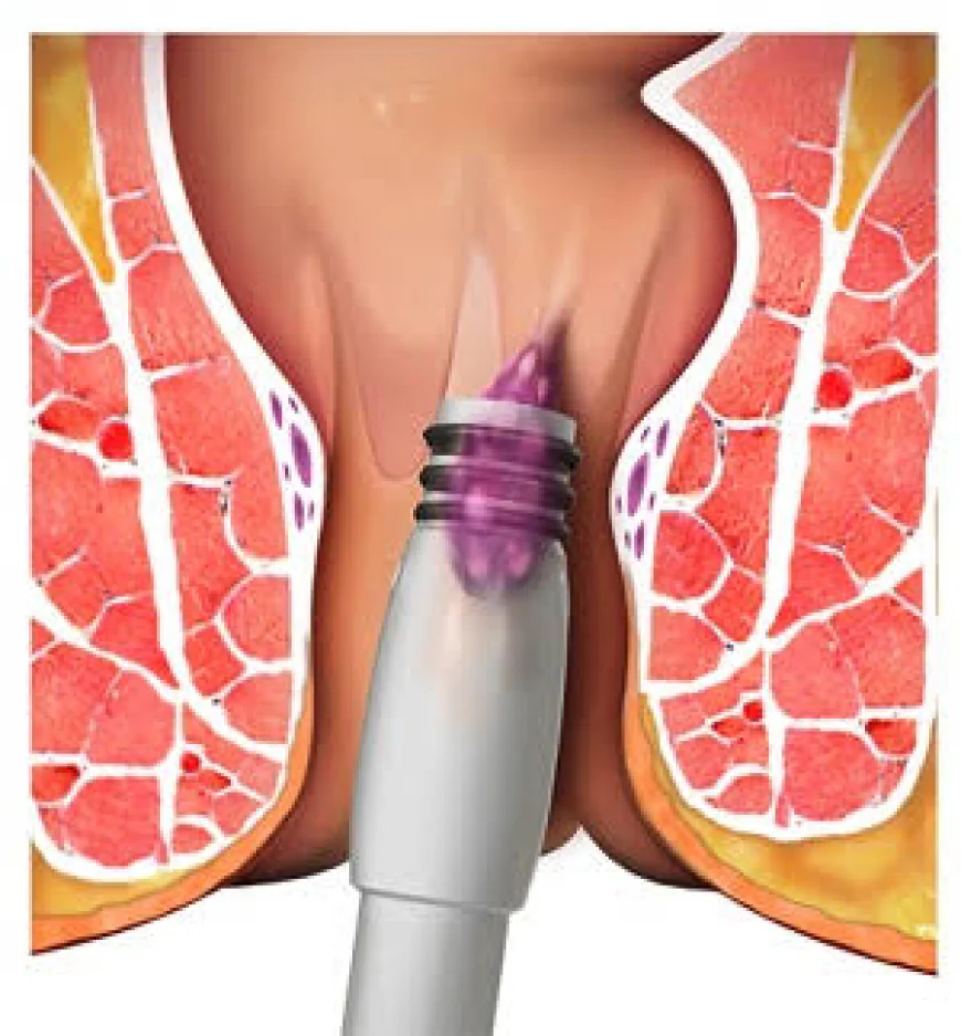 Understanding Non-Surgical Hemorrhoid Treatment in Dubai Options