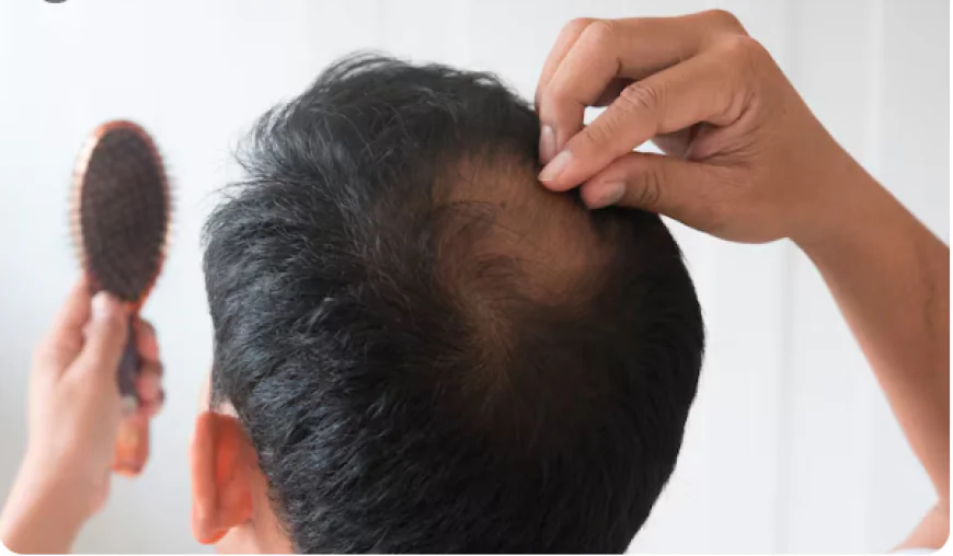 Effective Hair Loss Treatment in Beverly Hills, CA: Your Guide to Restoring Confidence