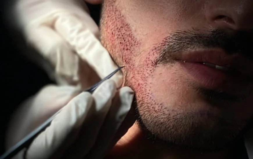 What Is Beard Growth Treatment?