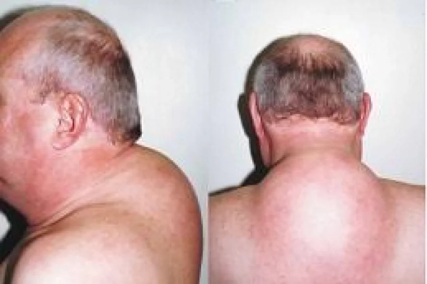 Buffalo Hump Removal in Dubai for Improved Neck Contours | Complete Guide