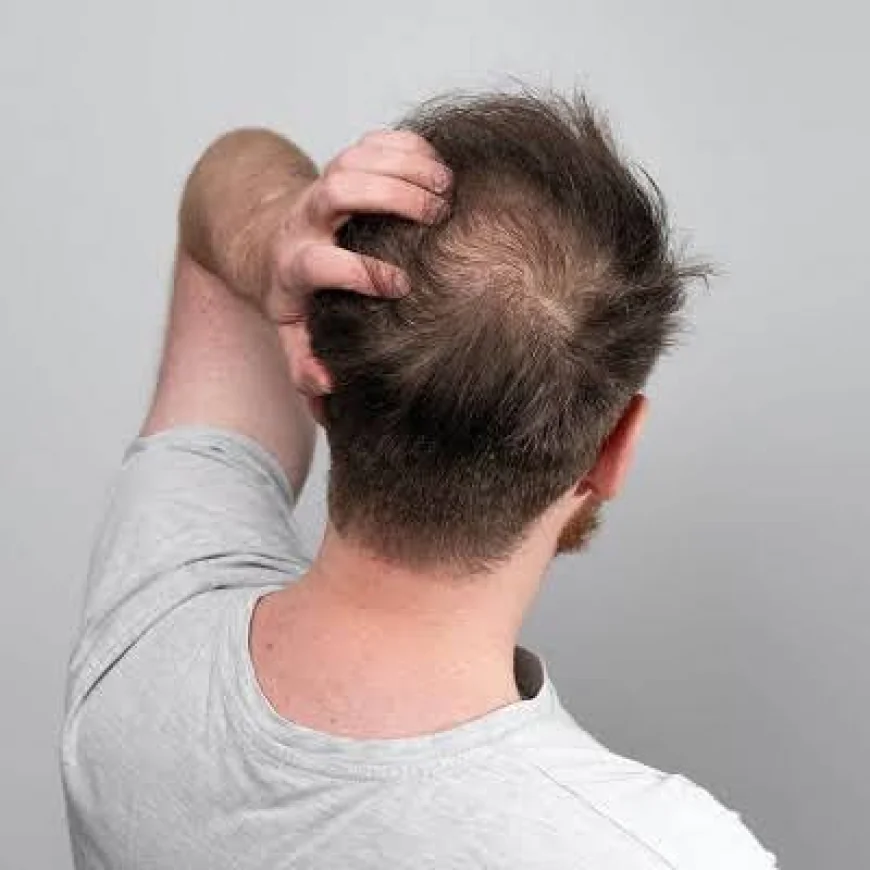 Crown Area Transplant in Dubai for Advanced Hair Thinning – Everything You Need to Know