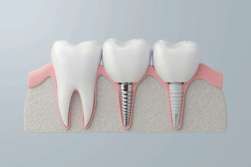 The Journey from Tooth Loss to Smile Restoration with Dental Implants