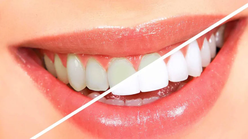 Teeth Whitening Dubai Benefits Beyond Appearance