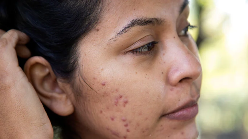 Does Acne Scar Treatments vary by scar severity levels