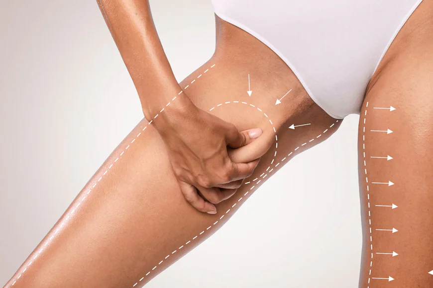 Can a Lower Body Lift Help Tighten Loose Skin?