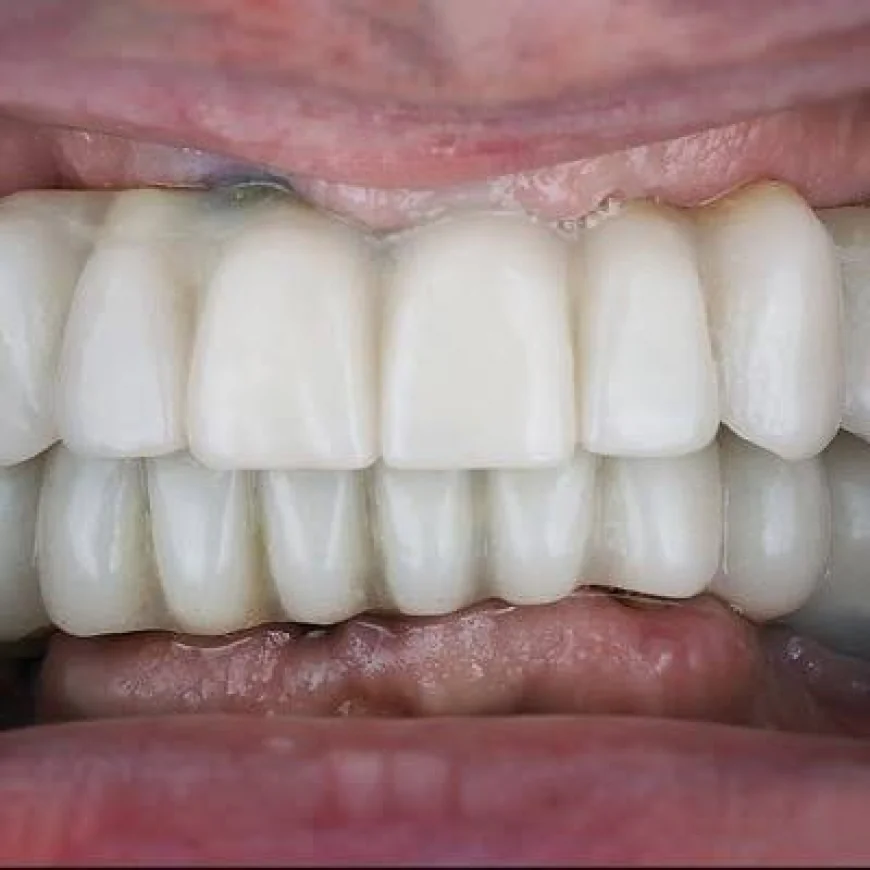 Why More People Are Choosing Dental Implants in Dubai for Long-Term Tooth Replacement