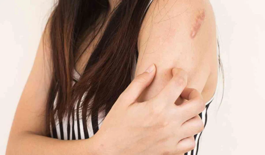 Can Keloid Treatment Deliver Remarkable Results for Skin Renewal?