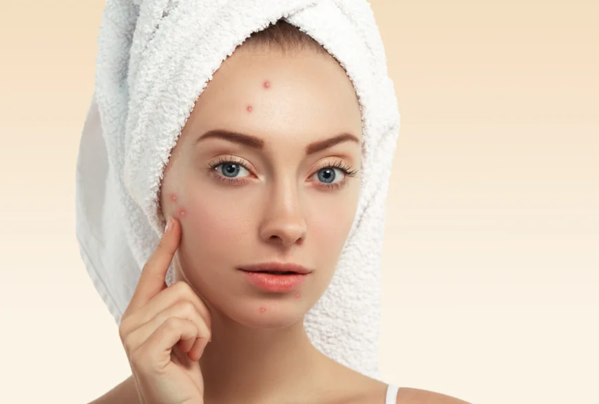 Acne Treatment in Manchester for Clear Skin Results