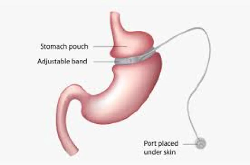 How Gastric Sleeve Surgery in Dubai Helps Transform Healthy Lifestyles