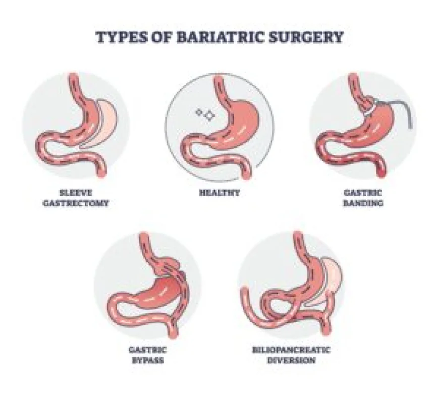 Understanding How Gastric Bypass in Dubai Helps Transform Lives