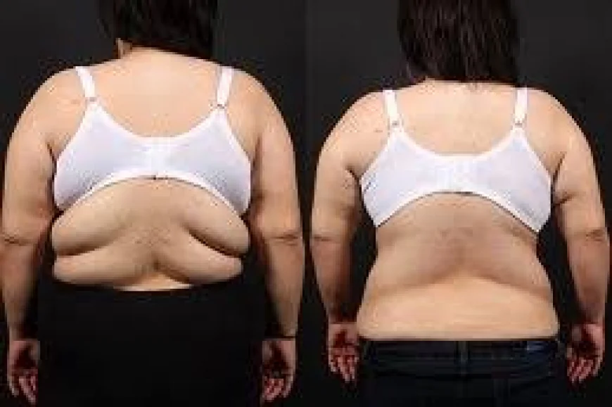 Back Lift in Dubai for a More Defined and Confident Appearance