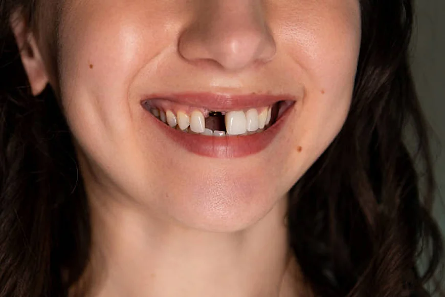 In Pakistan Tooth Fracture Treatment  Early Care Can Save Your Natural Smile: