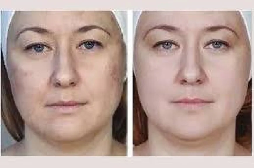 Understanding the Benefits of Mesotherapy for Bikini Area in Dubai