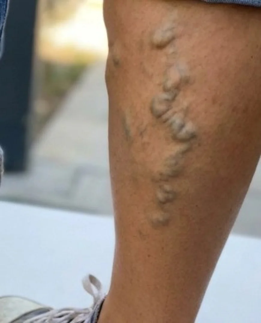 How Can Standing for Long Hours Impact the Need for Varicose Vein Treatment