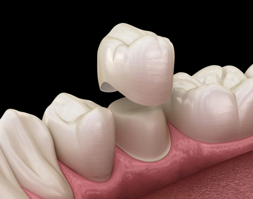 Teeth Whitening Service in Bikaner: Brighten Your Smile with Professional Dental Care