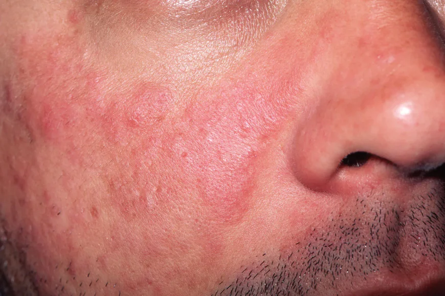 Can Children Develop Chronic Skin Conditions?