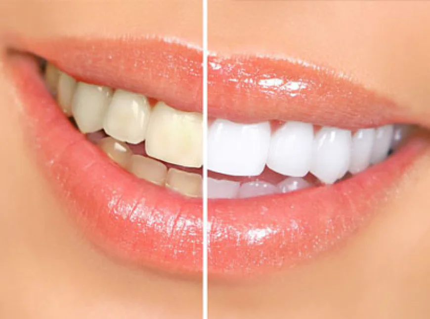 Porcelain Veneers Thousand Oaks: Expert Cosmetic Dentistry Near You