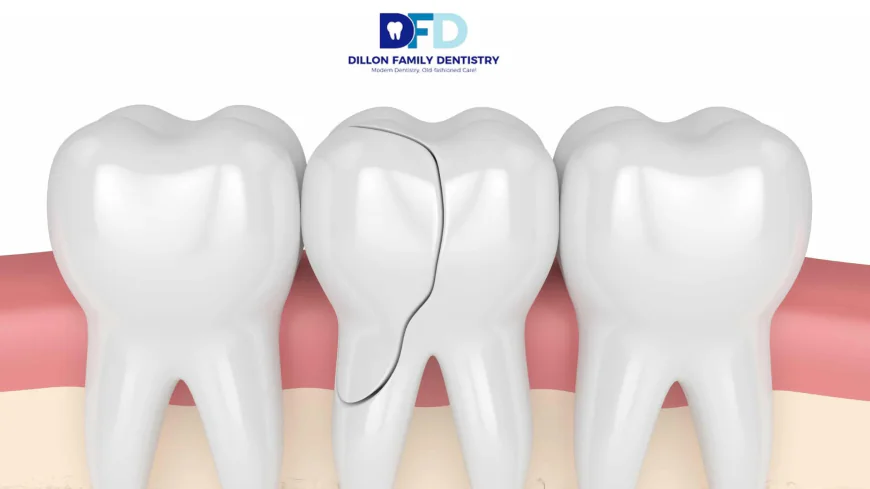 Cracked Tooth Emergency? What To Do | Dentist Bryn Mawr