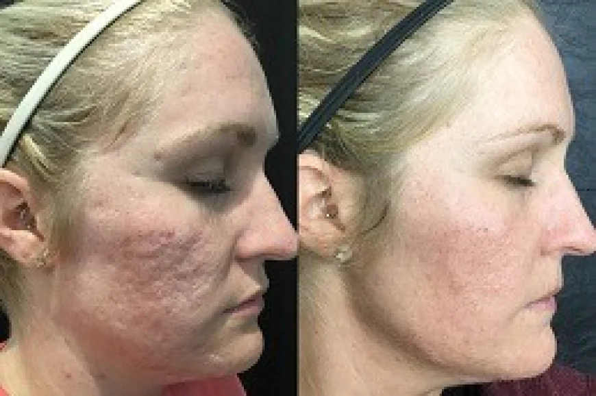 How Platelet-Rich Plasma (PRP) in Dubai Supports Natural Rejuvenation