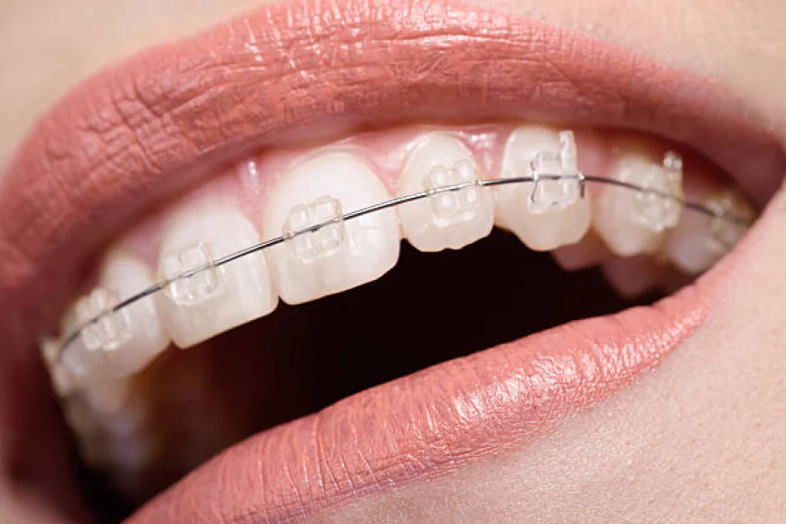 Smart Choice for a Perfect Smile Teeth Braces in Islamabad: