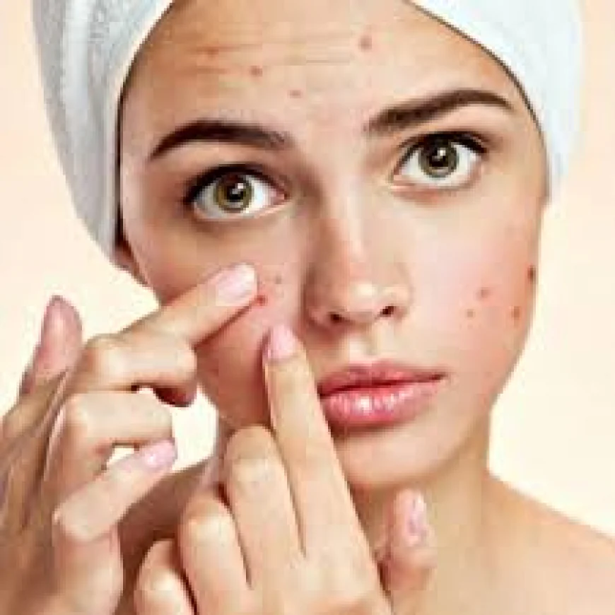 Acne Removal in Dubai: Treatments and Strategies for Long-Term Skin Clarity