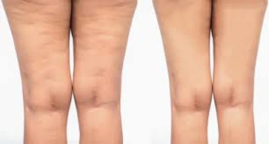Seborrheic Keratosis Treatment in Dubai – Safe and Effective Ways to Achieve Clear Skin
