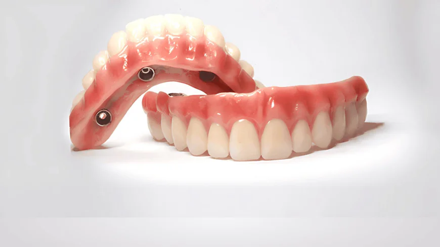 How Long Do Veneers in Dubai Typically Last?