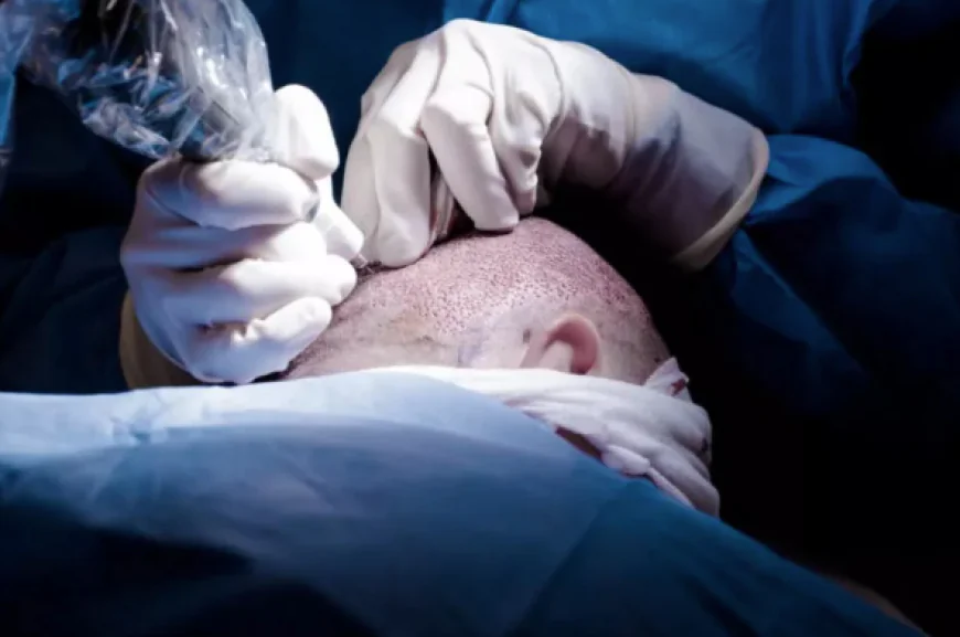 FUE Hair Transplant Istanbul: Advanced Hair Restoration in a Global Medical Hub