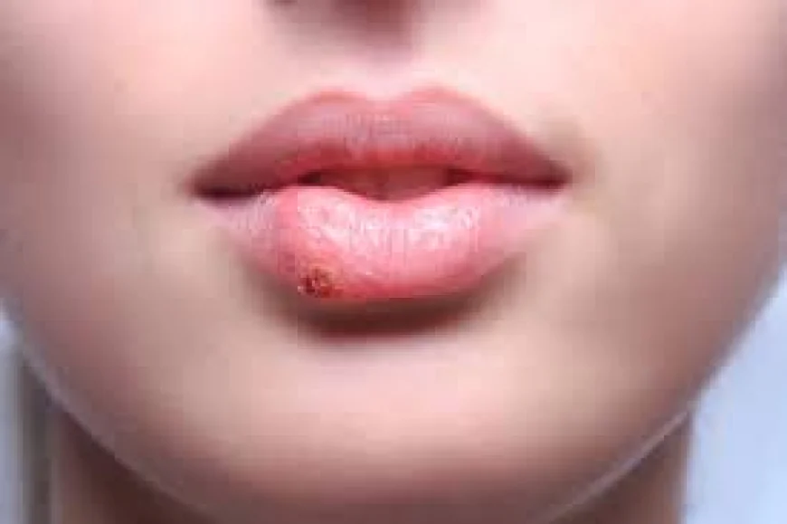 Lip Cancer: Symptoms and Causes