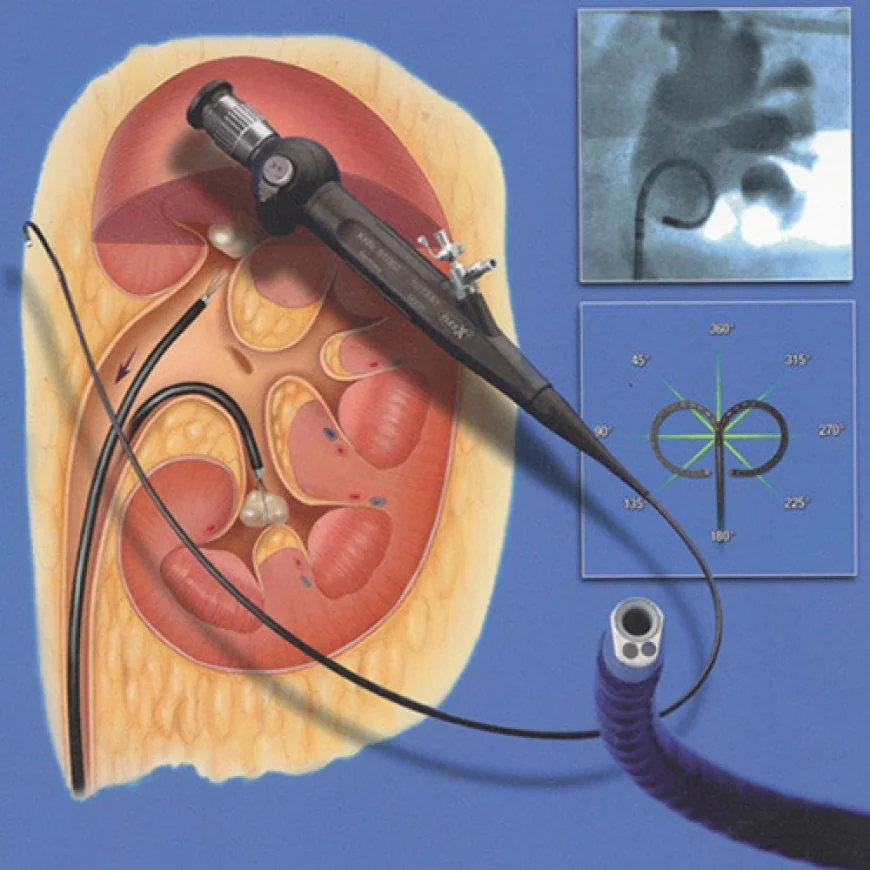 RIRS Surgery in Gurgaon