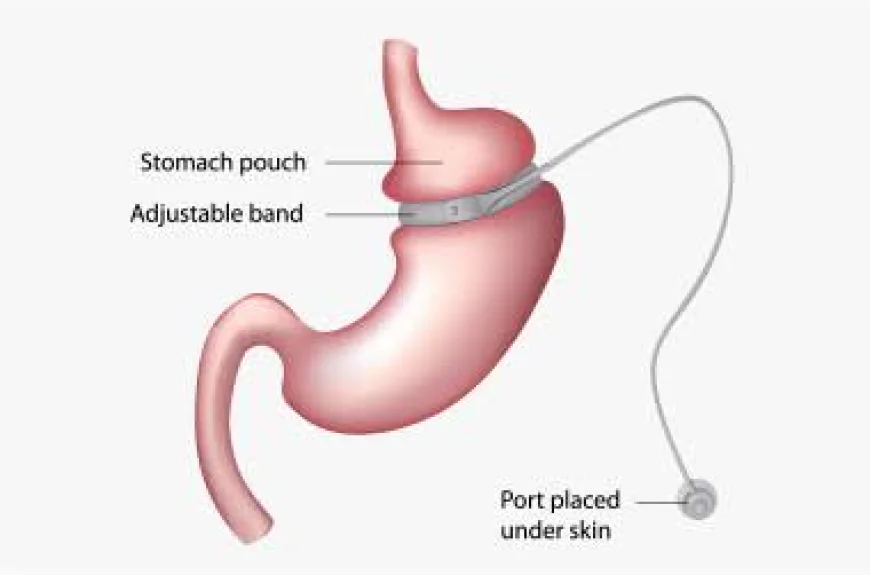Gastric Sleeve Surgery in Dubai: A Modern Approach to Long-Term Weight Loss