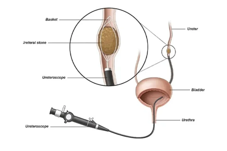 Laser URSL Surgery in Gurgaon