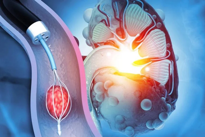 Mini Perc Surgery in Gurgaon: Advanced Treatment for Kidney Stones