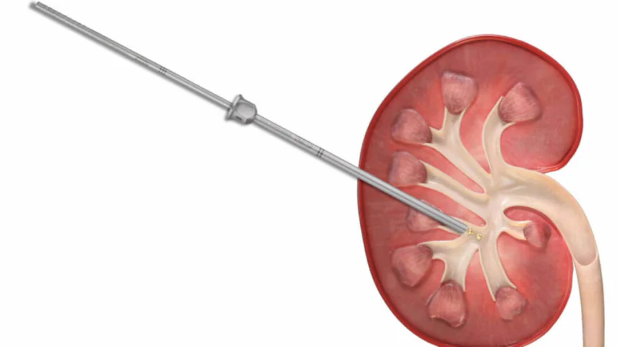Micro Perc Surgery in Gurgaon: A Minimally Invasive Solution for Kidney Stones