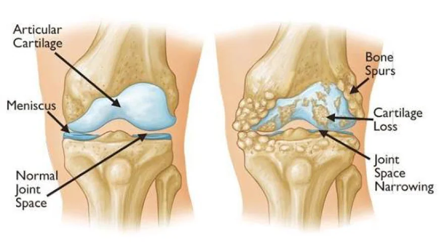 What Is the Difference Between Osteoarthritis and Arthritis?